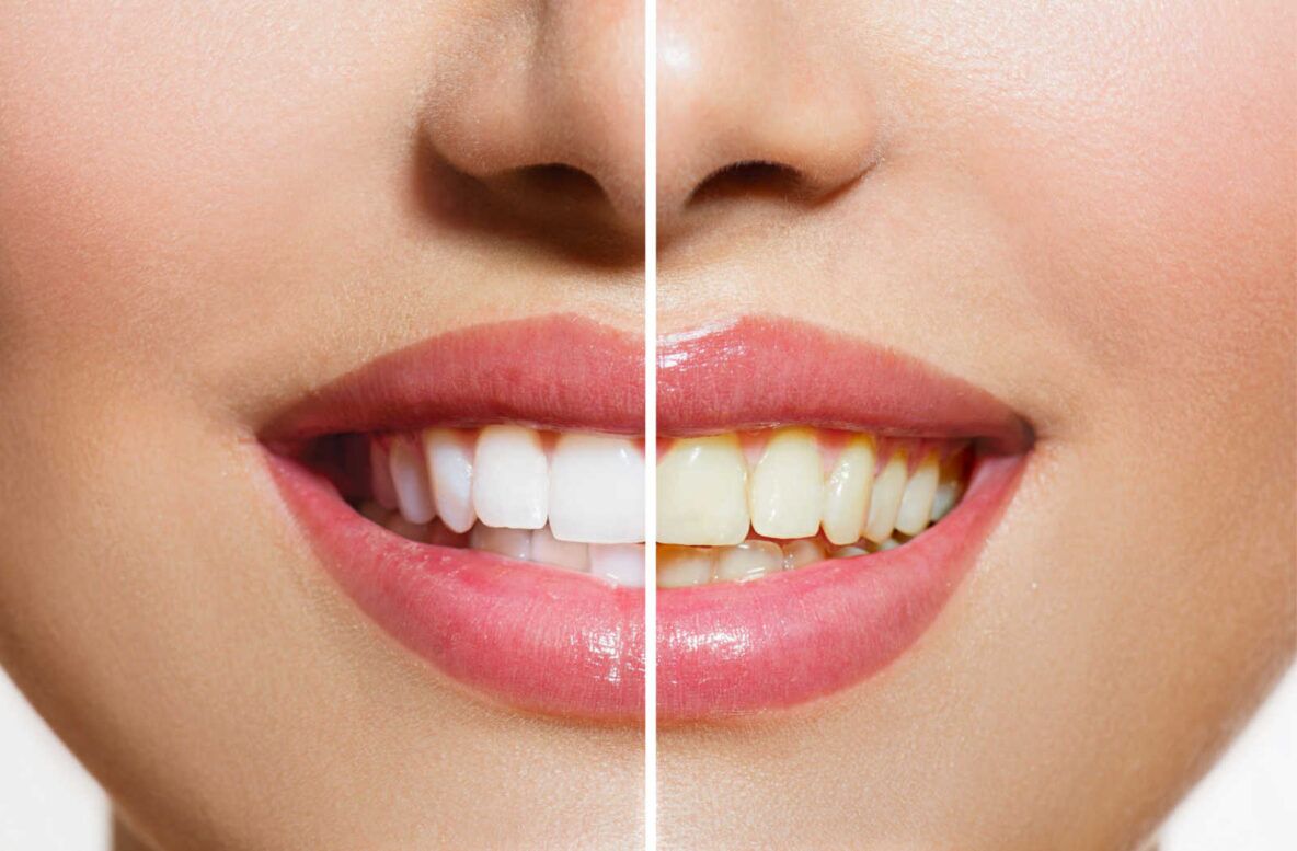 How-Much-Is-Teeth-Whitening-in-Edmonton_-Hero