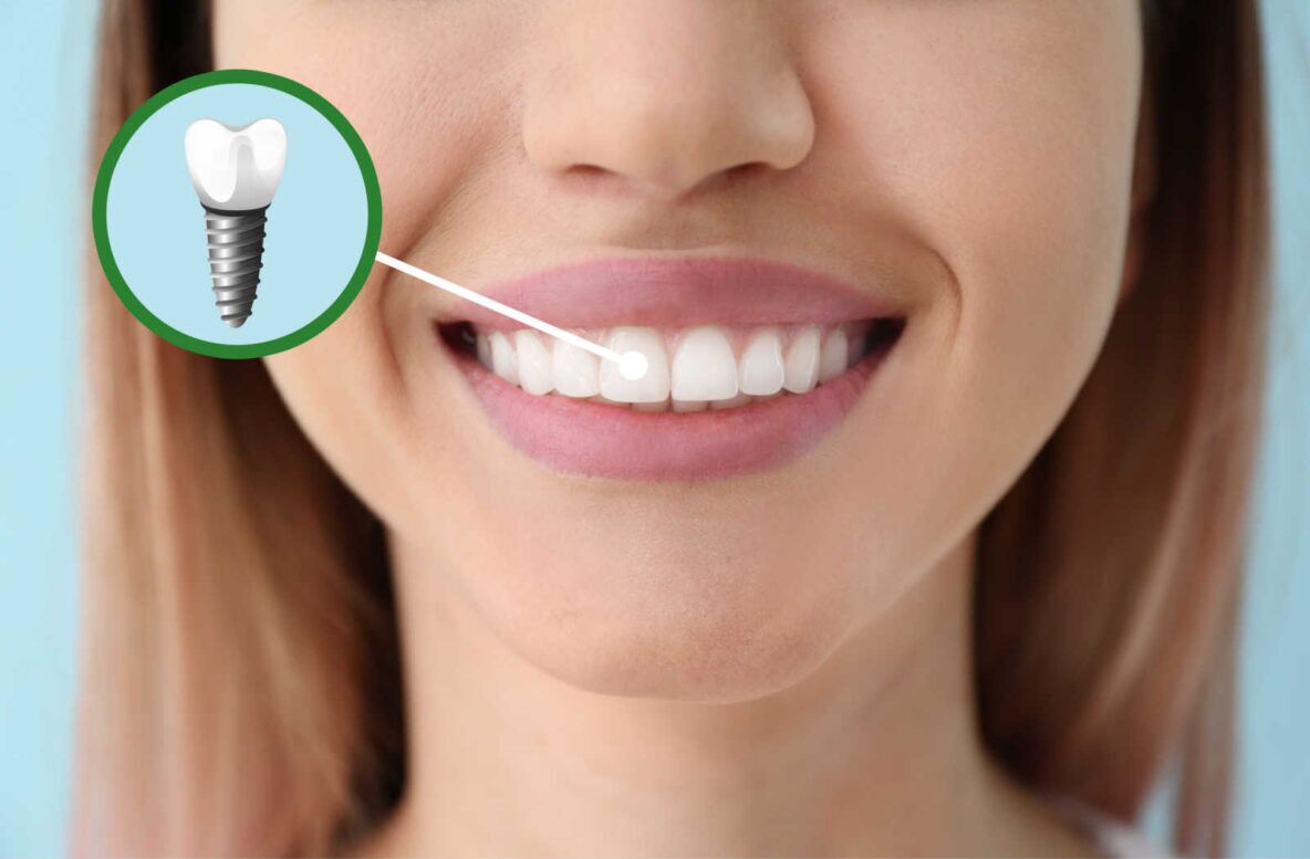 How Long Do Dental Implants Last - hero