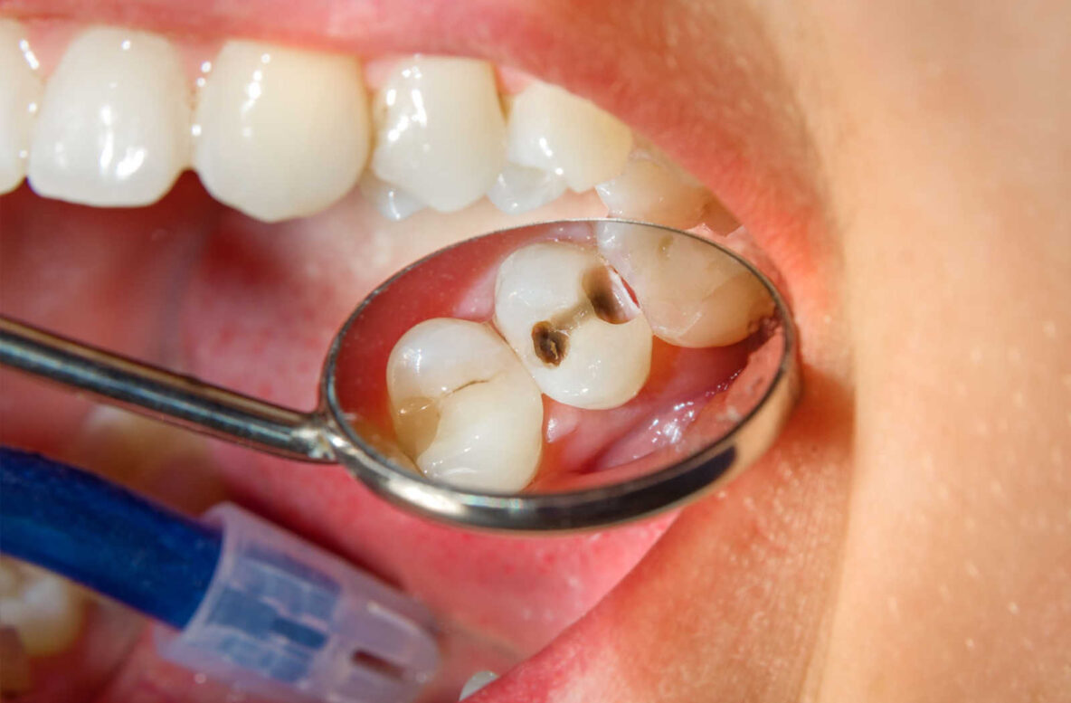 How-Long-Can-You-Leave-a-Cavity-Untreated_-Hero