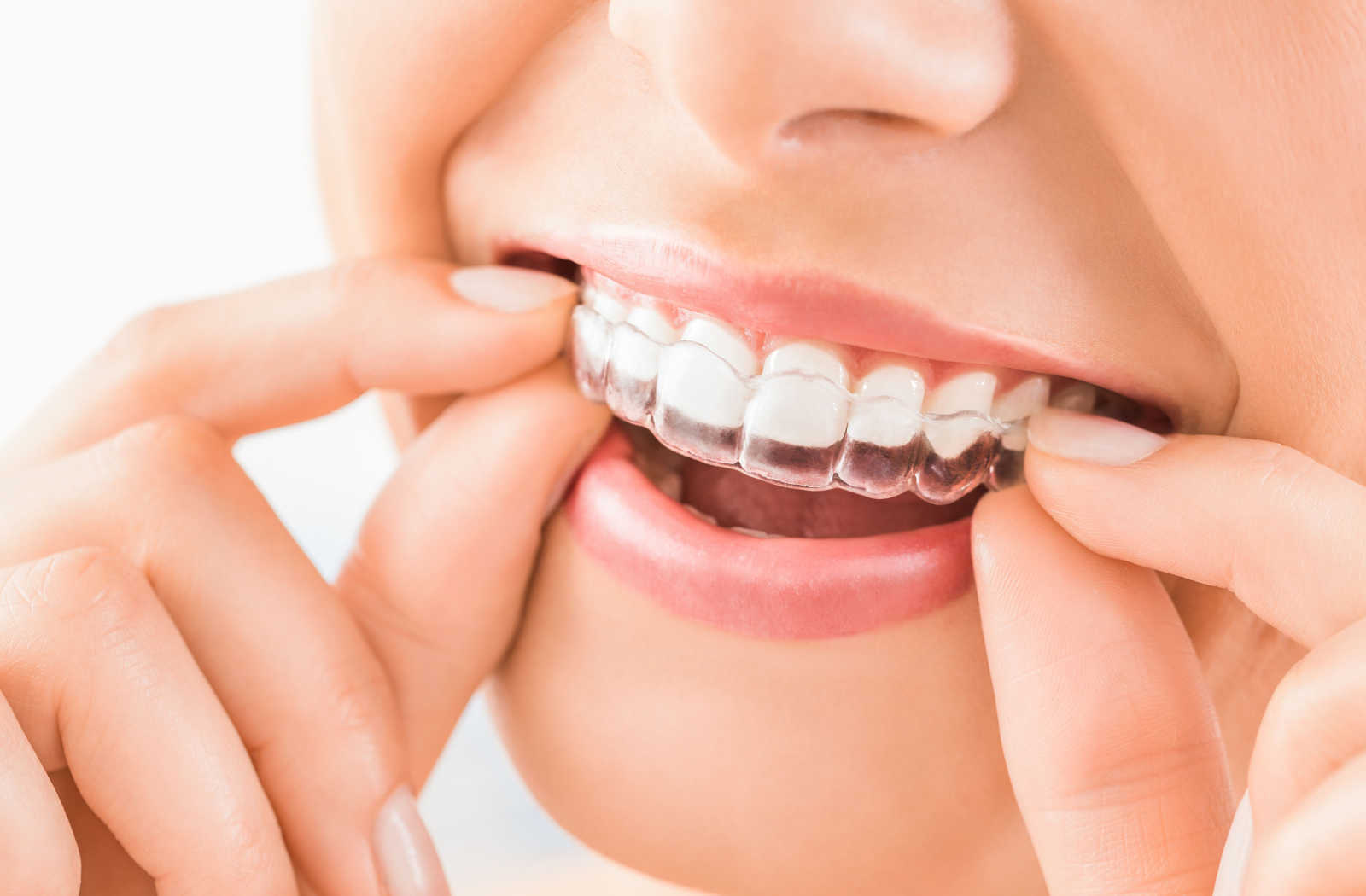 https://greengrovedentist.com/wp-content/uploads/2023/03/How-Much-Does-Invisalign-Cost-in-Edmonton_-Hero.jpg