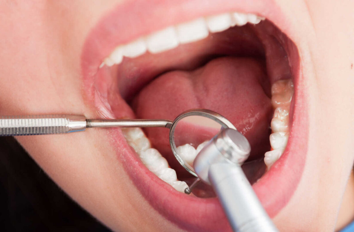how do dentists fix cavities - hero